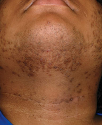 Cicatrisation,hyperpigmentation post-inflammatoire