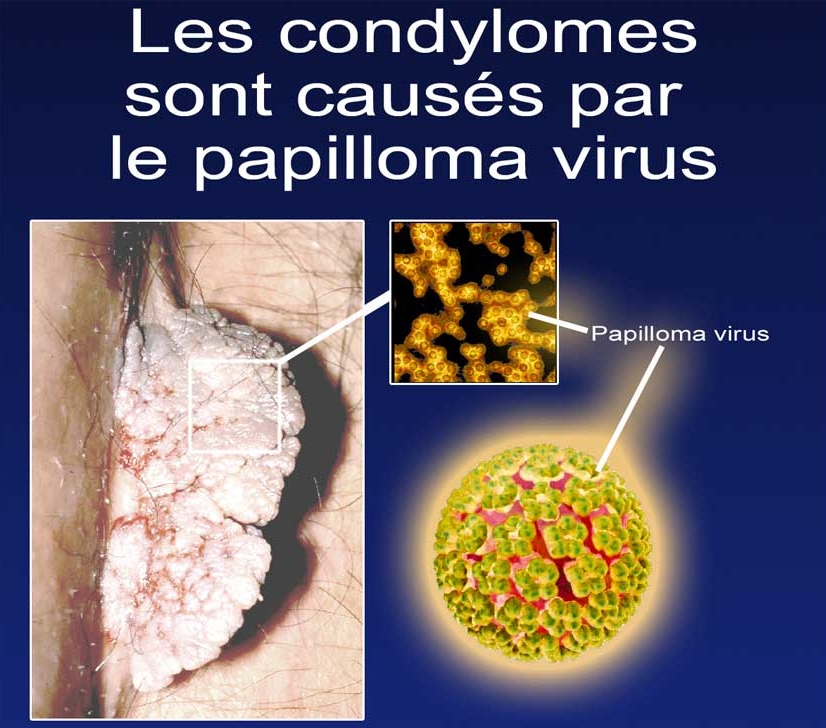 DERMATOINFO, Les Condylomes