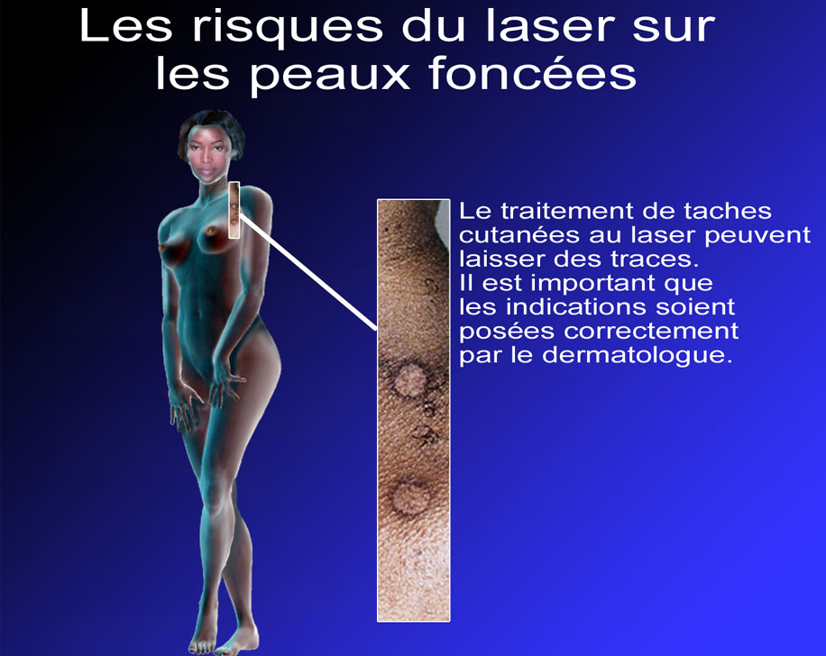 Les taches de pigment sur les pieds chez les hommes de la raison