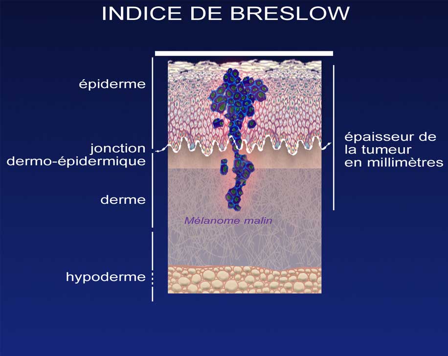 L'indice de Breslow et le mélanome