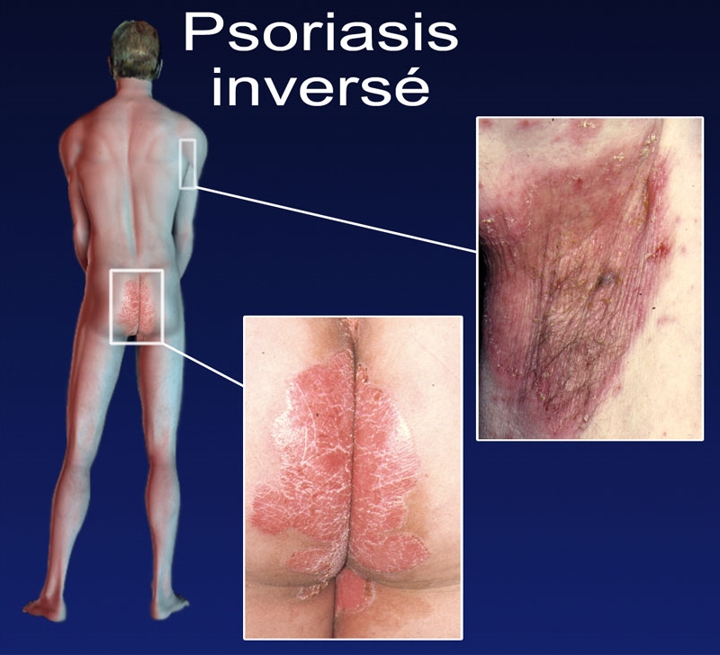 methotrexate for psoriasis