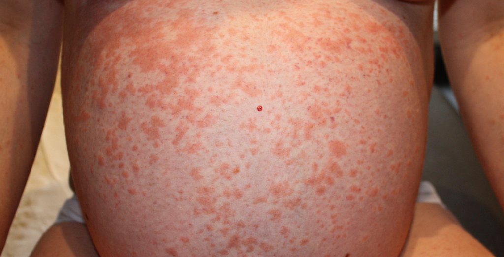 Dermato Info Eruption Polymorphe De La Grossesse