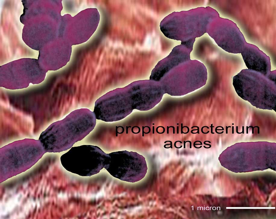 Bactérie de l'acné