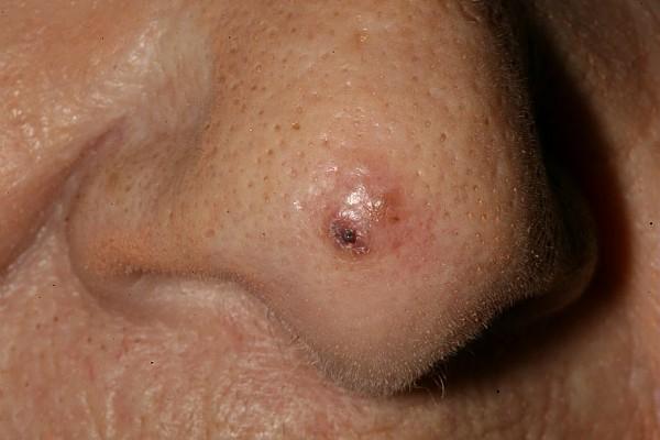 Exemple d’ un carcinome basocellulaire de la pointe du nez