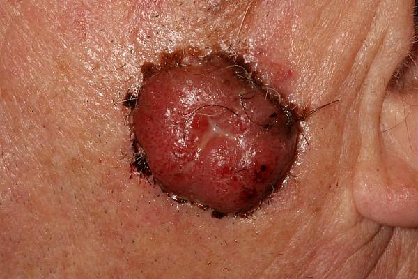 Exemple de carcinome spinocellulaire : typiquement lésion bourgeonnante, saignotante