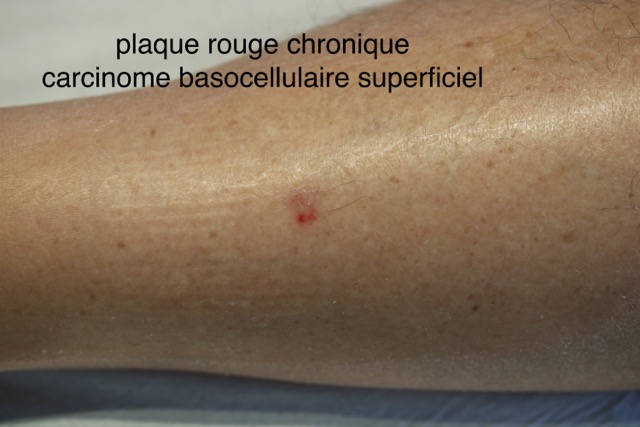 Carcinome basocellulaire