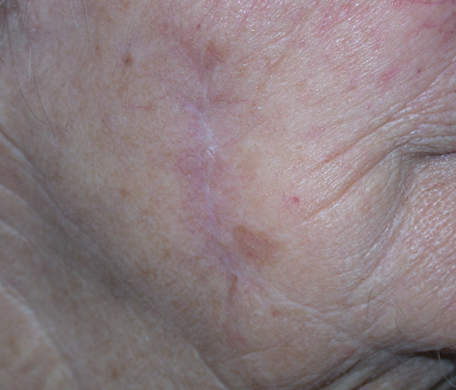 cicatrisation après traitement dermocorticoïde laser vasculaire