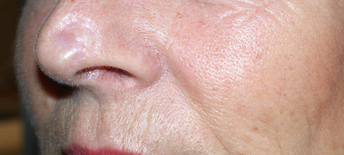 Cicatrice atrophique après greffe de peau totale
