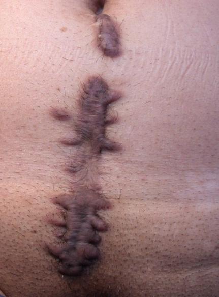 cicatrice chéloïde post chirurgicale