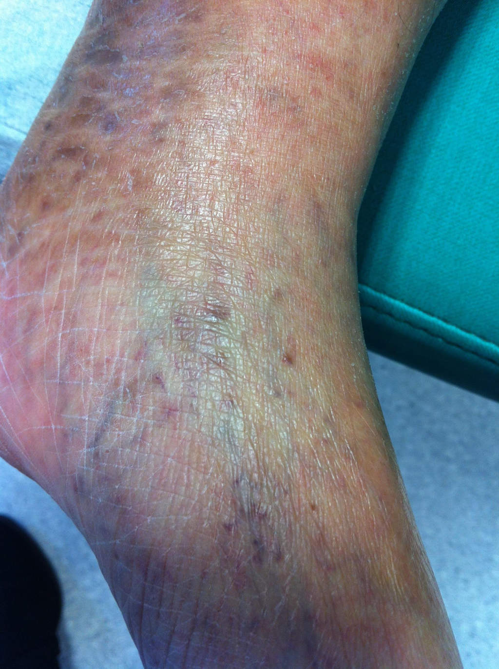 Taches Jambes Insuffisance Veineuse At Robert Lindsay Blog Taches Jambes Insuffisance Veineuse At Robert Lindsay Blog