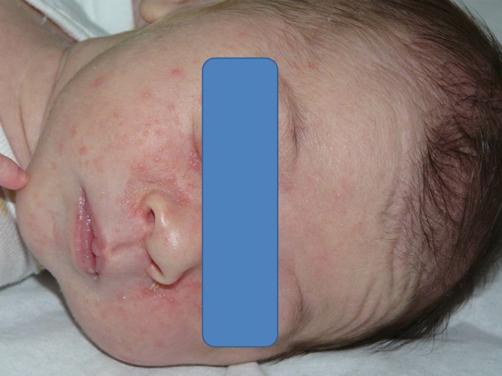 Dermato Info La Peau Du Nouveau Ne