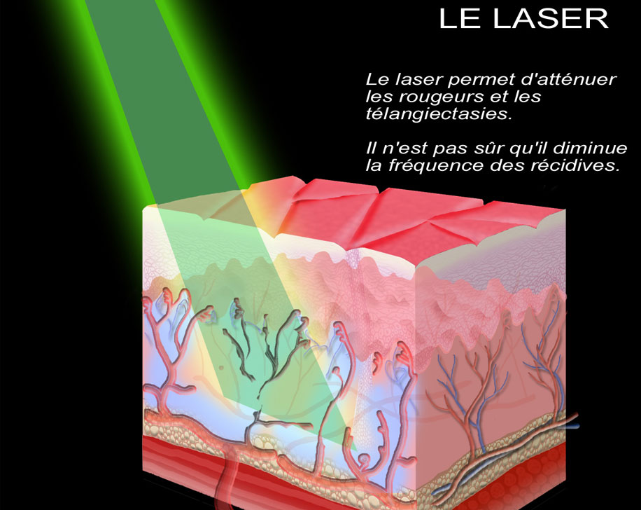 Laser dermatologique pour la rosacée