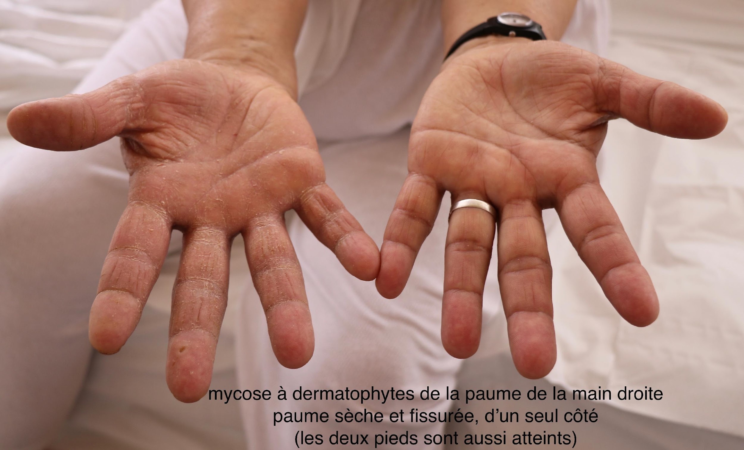 mycose à dermatophytes de la paume de la main droite