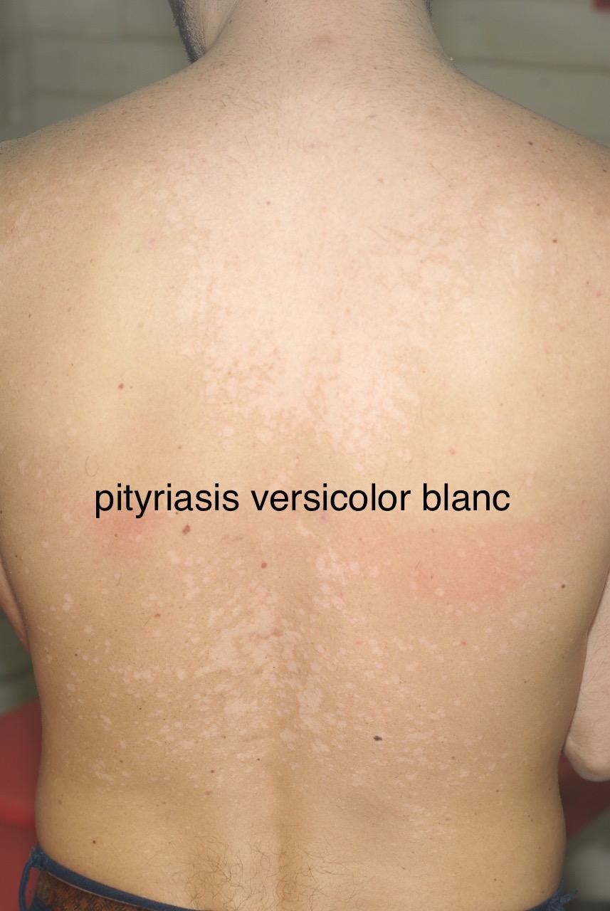 pityriasis versicolor blanc