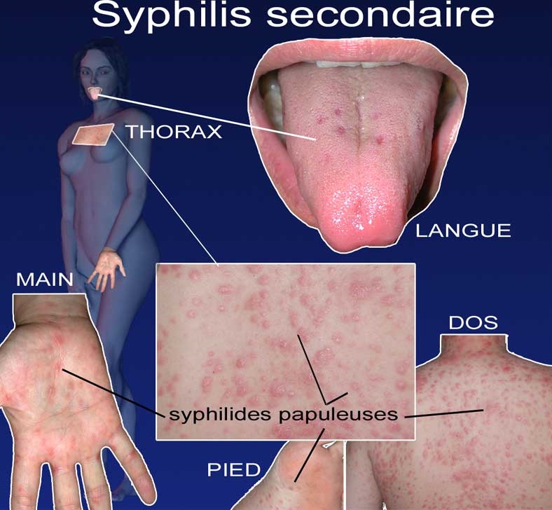 La syphilis tardive qui évolue depuis plus d'un an