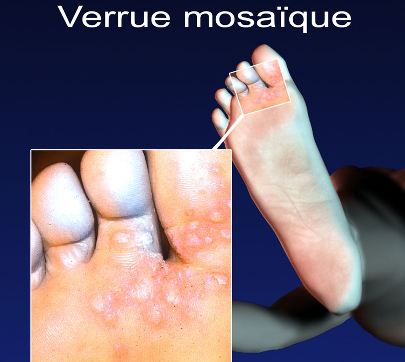 Quelle Est La Taille Des Verrues RRRM Quelle Est La Taille Des Verrues RRRM