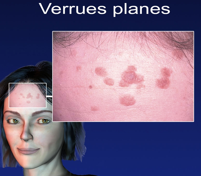 Hpv et cancer de la peau, Medicamente mezoterapie varicele, Papillomavirus probleme peau