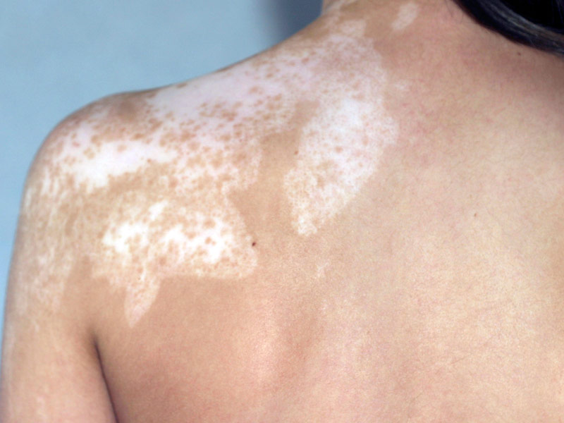 SFD : vitiligo segmentaire